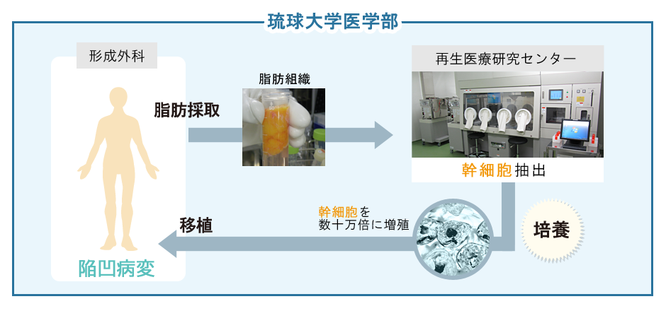 顔面陥凹性病変の治療のイメージ図